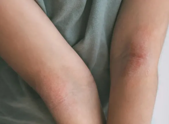 Czy pielęgnacja skóry z AZS powinna wyglądać inaczej latem niż zimą?