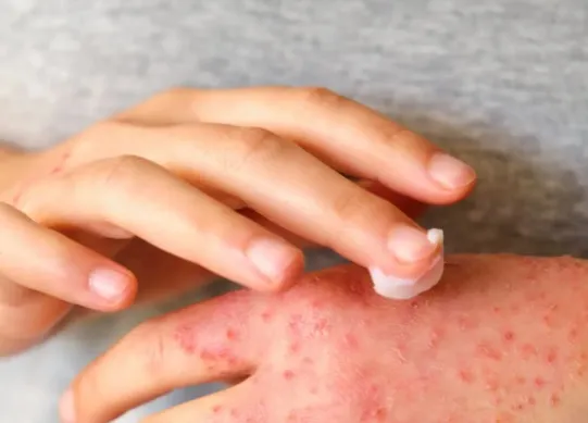 Jak stworzyć prosty i skuteczny plan pielęgnacji przy AZS?