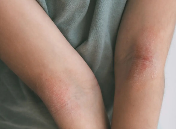 Jakie czynności pielęgnacyjne powinny wejść w nawyk osobom z AZS?